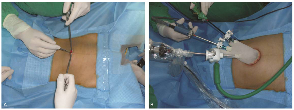 Single Site Laparoscopic Radical Hysterectomy Using Conventional Ports and Instruments