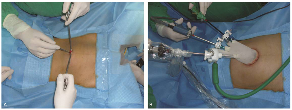 Single Site Laparoscopic Radical Hysterectomy Using Conventional Ports and Instruments Single Site Laparoscopic Radical Hysterectomy Using Conventional Ports and Instruments