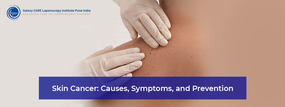 Skin Cancer: Causes, Symptoms, and Prevention Skin Cancer: Causes, Symptoms, and Prevention