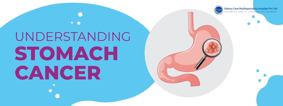 Understanding Stomach Cancer - Galaxy Care