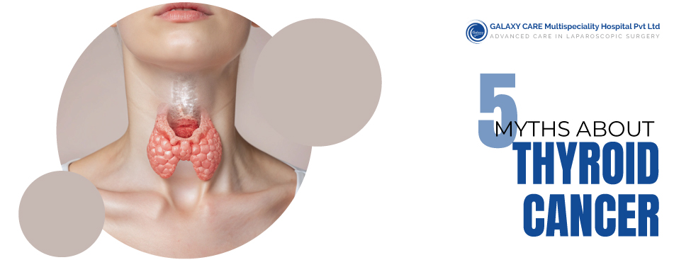 5 COMMON MYTHS ABOUT THYROID CANCER 5 COMMON MYTHS ABOUT THYROID CANCER