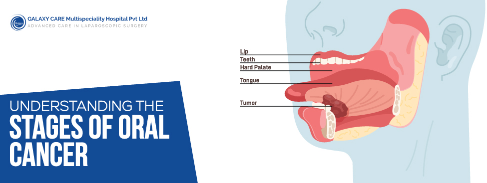 Understanding the Stages of Oral Cancer: A Guide for Patients Understanding the Stages of Oral Cancer: A Guide for Patients