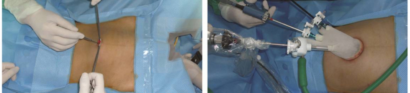 Single Site Laparoscopic Radical Hysterectomy Using Conventional Ports and Instruments